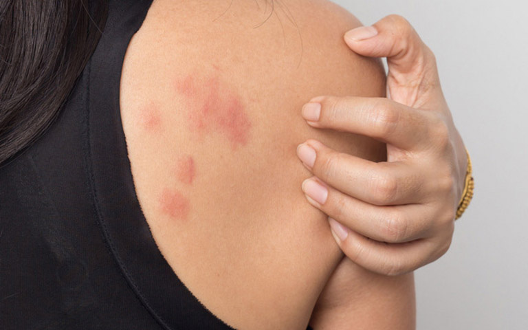 Dị ứng thời tiết nên kiêng ăn gì?