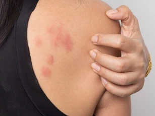 Dị ứng thời tiết nên kiêng ăn gì?