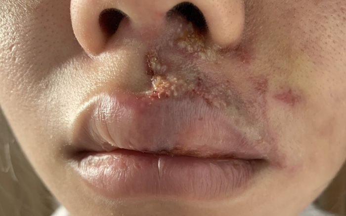 Mặt sưng phù, mưng mủ sau khi tiêm filler tại viện thẩm mỹ ở Sài Gòn