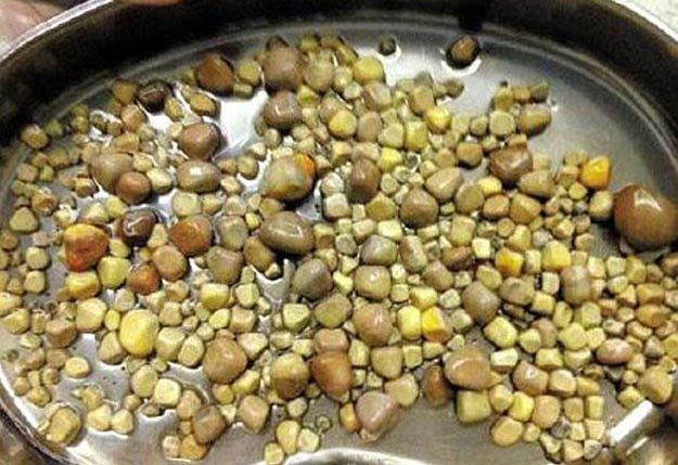 Mang 420 viên sỏi thận vì "nghiện" ăn đậu phụ