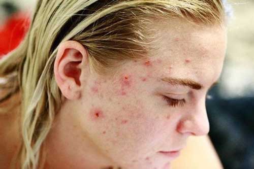7 mẹo nhỏ giải cứu làn da “vỡ trận” vì mụn