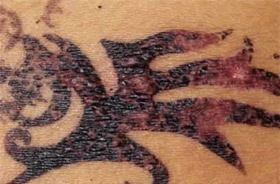  Mực xăm tạm thời, xăm henna đều có nguy cơ gây dị ứng da rất nguy hiểm. 