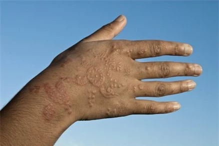  Mực xăm henna để lại sẹo lồi rất nguy hiểm. 