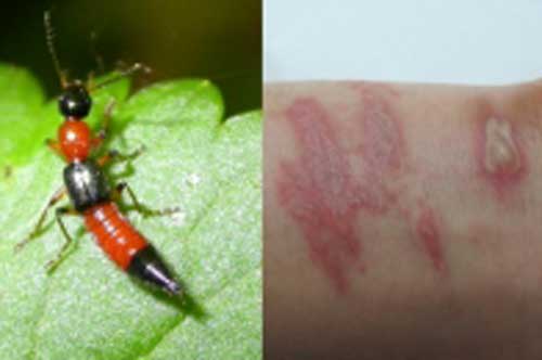 Độc tố của kiến ba khoang mạnh gấp 15 lần nọc rắn hổ mang: Khi bị đốt tuyết đối không được làm việc này