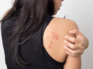 Những vết mẩn đỏ cảnh báo căn bệnh ung thư phổ biến