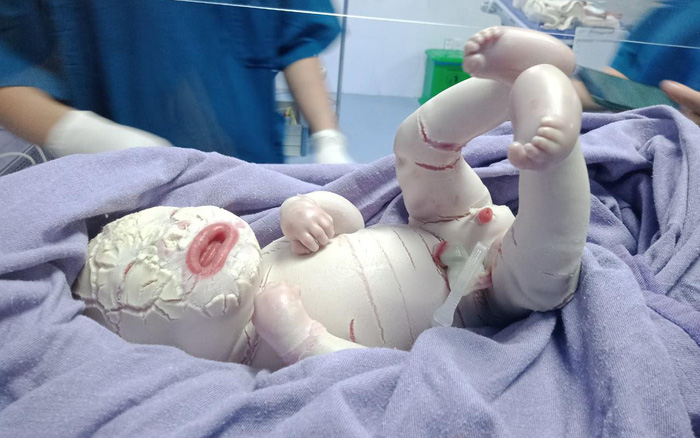 Xót xa hình ảnh bé sinh non da bị lớp sừng bao phủ, nứt toác