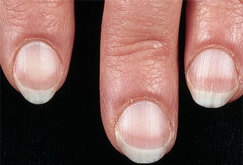  9 dấu hiệu cảnh báo bệnh tật trên móng tay: Dấu hiệu bệnh về gan rất dễ nhận biết - Ảnh 1.