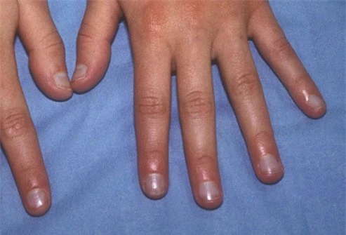  9 dấu hiệu cảnh báo bệnh tật trên móng tay: Dấu hiệu bệnh về gan rất dễ nhận biết - Ảnh 4.