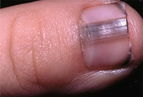  9 dấu hiệu cảnh báo bệnh tật trên móng tay: Dấu hiệu bệnh về gan rất dễ nhận biết - Ảnh 8.