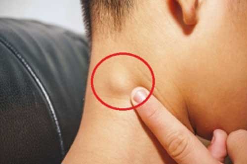 3 dấu hiệu ở cổ cảnh báo khối u ở tuyến giáp: Dù chỉ có 1 biểu hiện cũng phải đi khám gấp