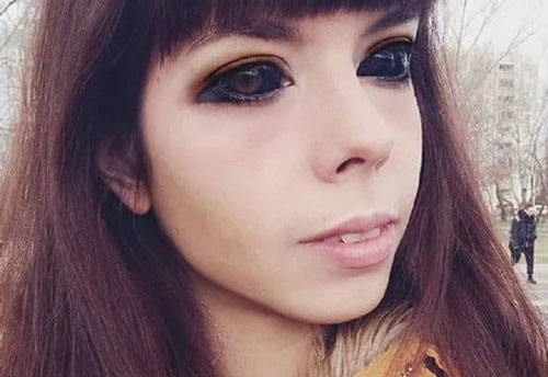 Cô gái bị mù sau khi xăm mực đen lên mắt để có vẻ ngoài giống thần tượng