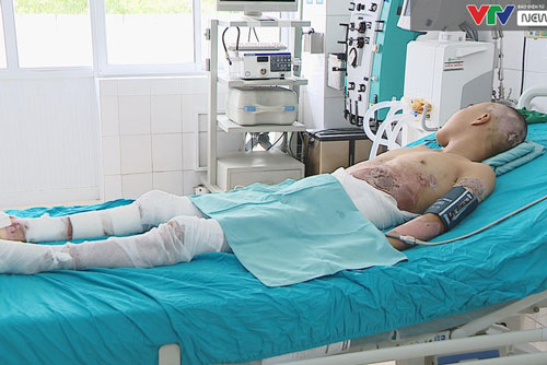 Cầm thanh kim loại gần đường điện cao thế, nam thanh niên bỏng nặng, tổn thương nặng