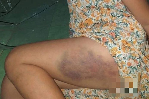 Xác minh việc học sinh lớp 3 bị cô giáo đánh bầm tím đùi