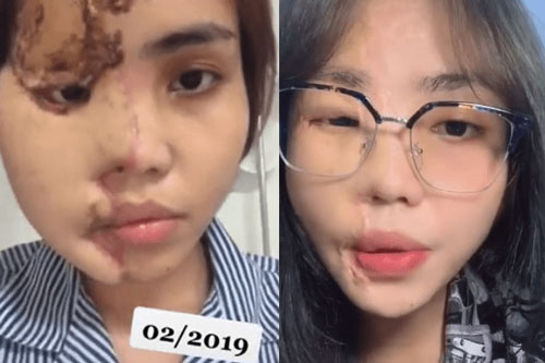 Cô gái bị hôn phu tạt axit hủy hoại nửa gương mặt gần 2 năm trước giờ ra sao?