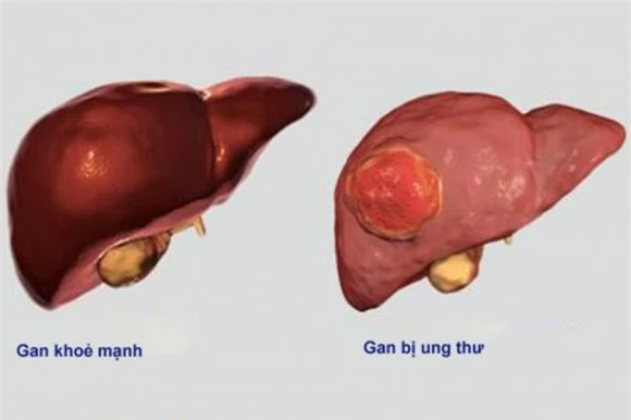 Lưu ý những dấu hiệu cảnh báo ung thư gan 