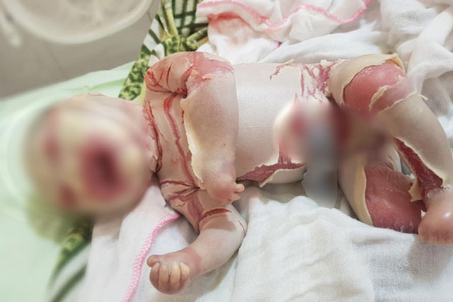 Thêm 1 trẻ sơ sinh chào đời với lớp sừng dày, nứt thành kẽ sâu