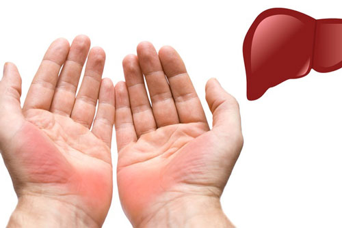 Lưu ý những dấu hiệu cảnh báo ung thư gan