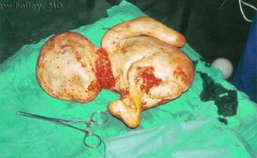 Chuyện lạ: Bào thai hóa thạch 50 năm, nặng 2 kg nằm trong bụng bà lão 90 tuổi