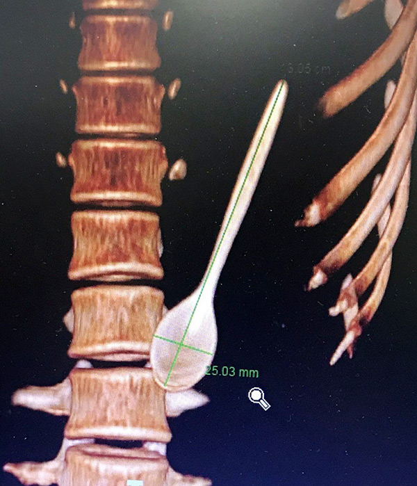 Bệnh viện Đà Nẵng liên tiếp cấp cứu hai trường hợp nuốt muỗng nhựa, răng giả