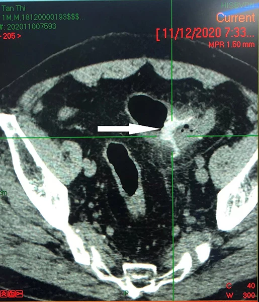 Hnhf chụp CT scan