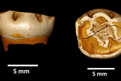 Chiếc răng lạ tiết lộ đứa trẻ y hệt nhưng không phải loài người chúng ta