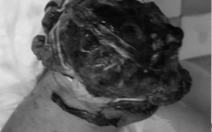 Nấu ăn bằng bình gas mini, người đàn ông bị mất cánh tay phải và chấn thương sọ não