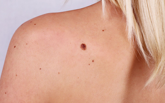 Cách phân biệt nốt ruồi ung thư và nốt ruồi thường