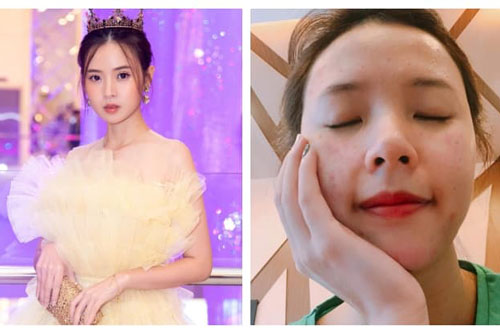Midu tiết lộ từng giam mình một tháng, đăng luôn ảnh xấu nhất với mặt đầy mụn