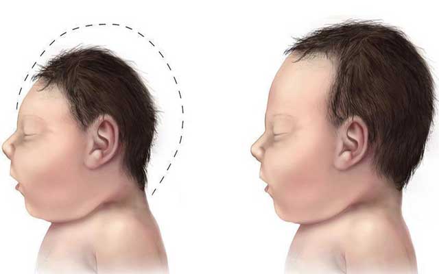 Nguyên nhân gây tật đầu nhỏ ở trẻ sơ sinh?