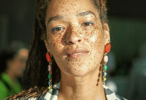 Nữ người mẫu có gương mặt toàn tàn nhang