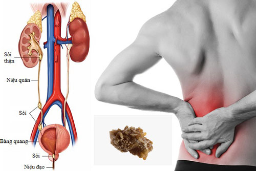 4 loại nước giúp chữa trị và phòng ngừa sỏi thận