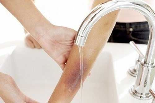 Các biện pháp ngăn ngừa hình thành sẹo bỏng đơn giản ngay tại nhà