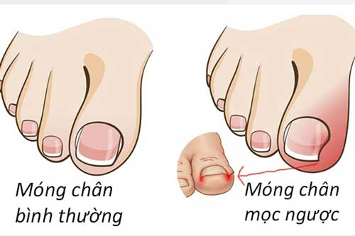 Lỗi sai khi cắt móng tay dễ gây viêm nhiễm đau đớn, nhiều người vô tình mắc phải mà không biết