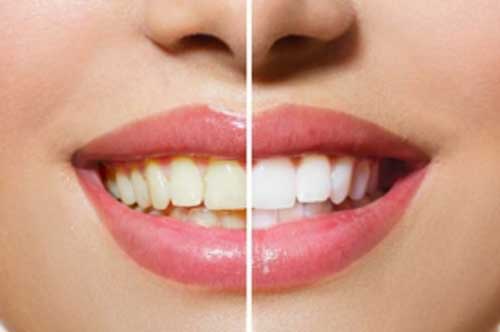 Cách đánh bay vết ố vàng trên răng ngay tại nhà bằng nguyên liệu hoàn toàn tự nhiên