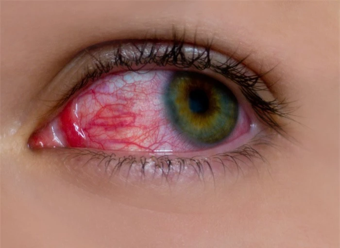 Những con đường lây nhiễm đau mắt đỏ: Nhìn vào mắt người bị đau mắt đỏ có lây không? - Ảnh 2.