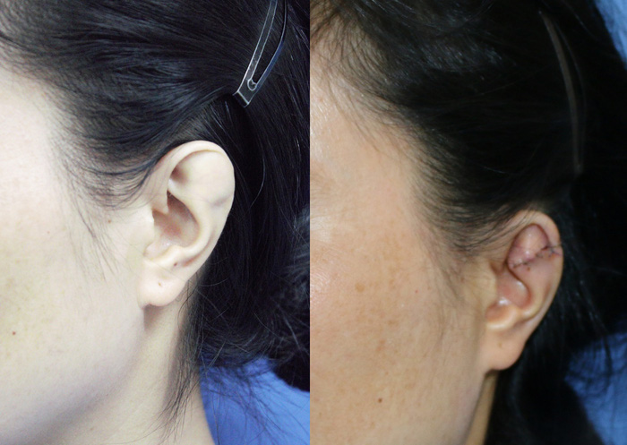 Hơn 30 năm sống trong mặc cảm vì đôi tai khác thường