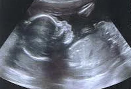 Chuyện lạ: Thai nhi chào đời sau 3 tháng trong bụng tử thi