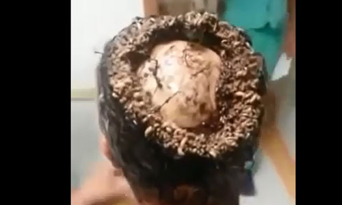 Sự thật động trời về tin giòi ăn não người từ tóc nối
