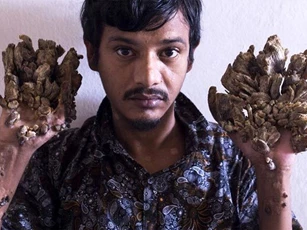 'Người cây' Bangladesh cầu xin được cắt cụt tay