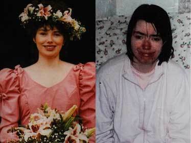 Cô gái chết vì tắm 20 giờ mỗi ngày