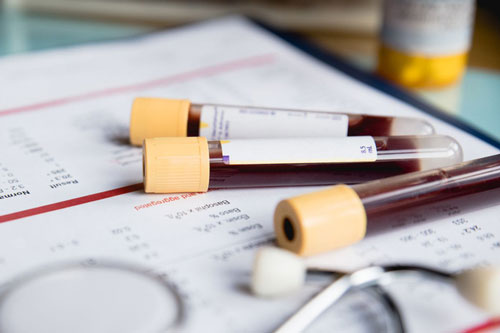 Thử máu giúp phát hiện 50 loại ung thư tại Anh