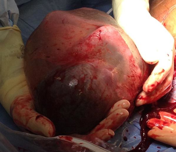 Chuyện lạ: Thai nhi chào đời còn nguyên trong túi ối