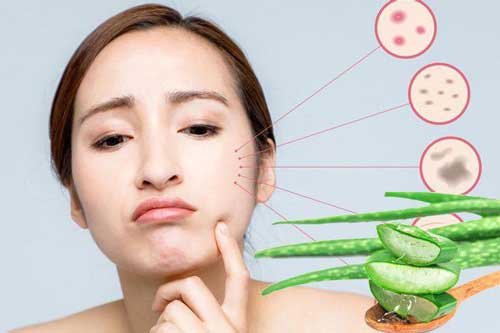 Bật mí 5 cách dưỡng trắng da bằng nha đam "dễ như trở bàn tay"