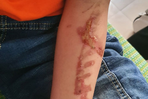 Khởi tố chủ quán bánh xèo hành hạ nhân viên