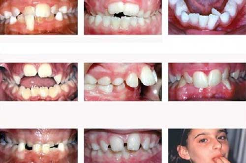 "Thủ phạm" bất ngờ gây răng mọc lệch ở trẻ nhỏ bất cứ bậc cha mẹ nào cũng nên biết