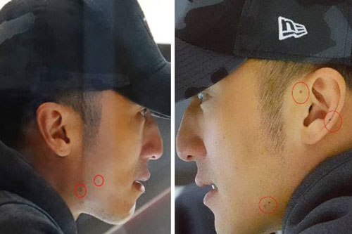 Từng phải phẫu thuật vì ung thư da, Tạ Đình Phong gây lo lắng khi xuất hiện nhiều dấu vết lạ trên mặt