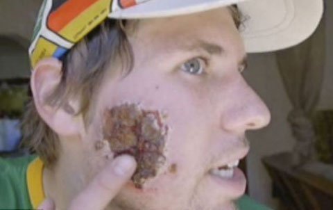 Bệnh lạ: 'Quái vật' chuyên ăn ruỗng mặt người