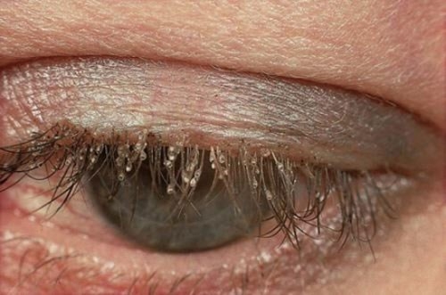 Hốt hoảng khi phát hiện tổ rận gồm 20 con trong mắt