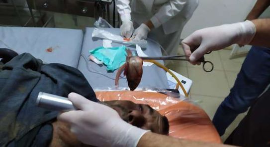 Tai nạn kỳ lạ khiến người đàn ông bị cá sống mắc kẹt trong cổ họng