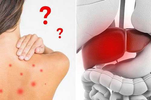 Những dấu hiệu cảnh báo bệnh gan, đừng chủ quan kẻo hối hận không kịp